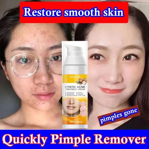 Gel Trị Mụn Nhanh - Hỗ Trợ Giảm Mụn Trong 3 Ngày, Kiểm Soát Dầu, Làm Mờ Vết Thâm Da - Sản Phẩm Cho Da Dầu, Da Dễ Nổi Mụn