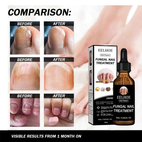 Serum Dưỡng Móng Eelhoe 30ml - Hỗ Trợ Loại Bỏ Nấm Móng, Cải Thiện Móng Hư Tổn, Dưỡng Chắc Khỏe Tự Nhiên