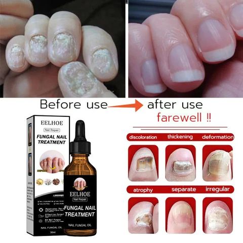 Serum Dưỡng Móng Eelhoe 30ml - Hỗ Trợ Loại Bỏ Nấm Móng, Cải Thiện Móng Hư Tổn, Dưỡng Chắc Khỏe Tự Nhiên