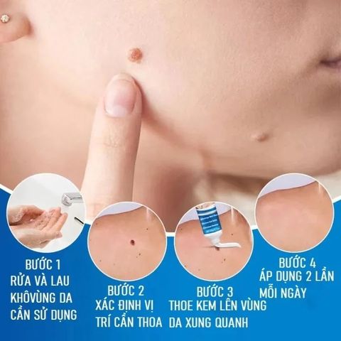 Kem Tẩy Nốt Ruồi & Lột Mụn Cóc 20g - Giải Pháp Hiệu Quả Cho Làn Da Mịn Màng, Dưỡng Ẩm Chuyên Sâu