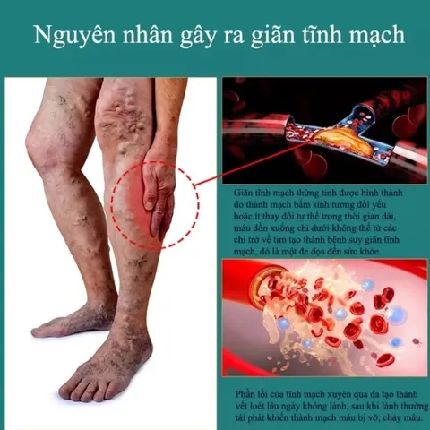 Xit Loại Bỏ Giãn Tĩnh Mạch Kem bôi giãn tĩnh mạch