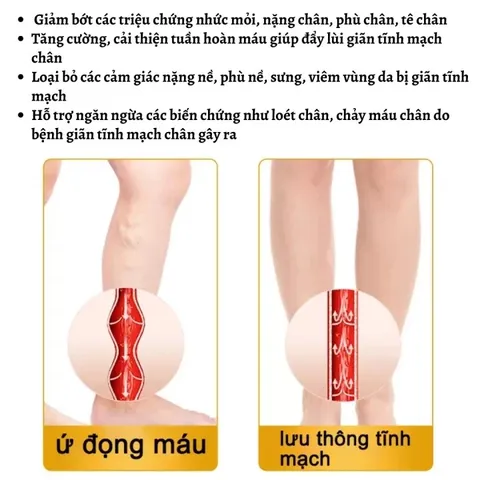 Xit Loại Bỏ Giãn Tĩnh Mạch Kem bôi giãn tĩnh mạch