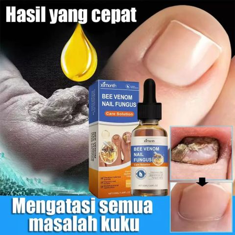 Tinh chất loại bỏ nấm móng Tinh chất bôi móng phục hồi giảm nấm 50ML