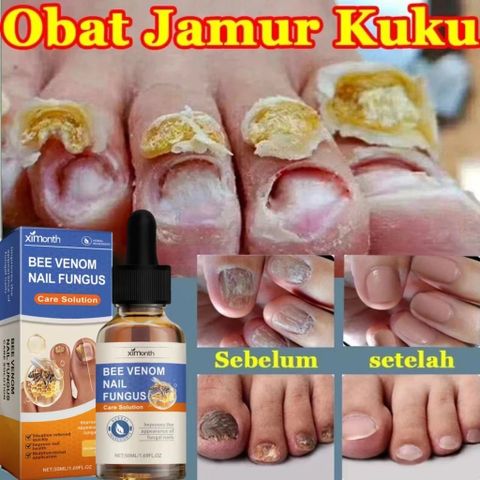 Tinh chất loại bỏ nấm móng Tinh chất bôi móng phục hồi giảm nấm 50ML