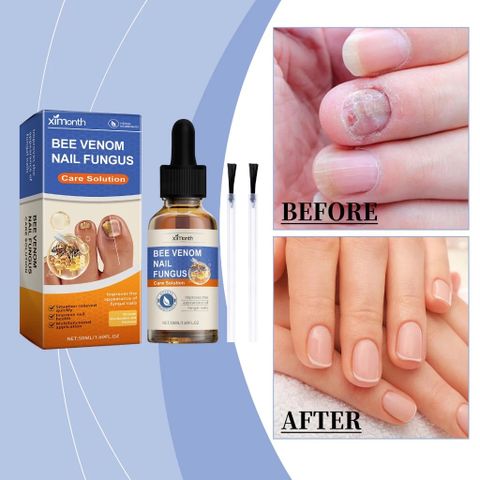 Tinh chất loại bỏ nấm móng Tinh chất bôi móng phục hồi giảm nấm 50ML