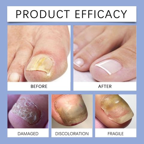 Tinh chất loại bỏ nấm móng Tinh chất bôi móng phục hồi giảm nấm 50ML