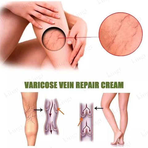  Kem suy giãn tĩnh mạch 50g giúp giảm đau mỏi tê phù chuột rút do suy giãn tĩnh mạch