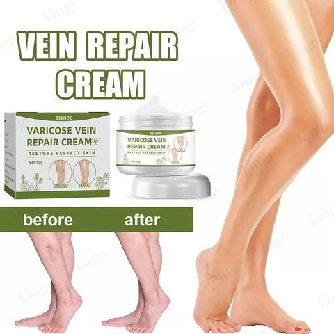  Kem suy giãn tĩnh mạch 50g giúp giảm đau mỏi tê phù chuột rút do suy giãn tĩnh mạch