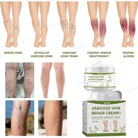  Kem suy giãn tĩnh mạch 50g giúp giảm đau mỏi tê phù chuột rút do suy giãn tĩnh mạch