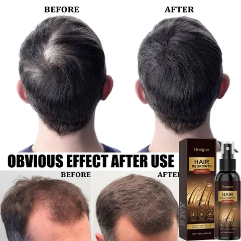 Xịt Kích Thích Mọc Tóc Nhanh 100ML- Phục Hồi Nang Tóc, Giảm Rụng Tóc