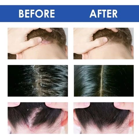 Kem Bôi Nấm Ngứa Viêm Da Cơ Địa NHẬT BẢN Hắc Lào, Tổ Đỉa, Vẩy Nến, Á Sừng, Lang Ben Hiệu Quả