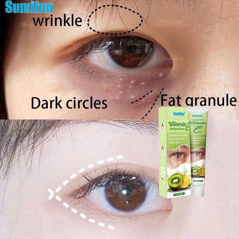 Mụn Thịt Quanh Mắt - Kem Mắt Vitamin E Nguyên Chất Giảm Thâm, Xóa Nhăn, Căng Bóng
