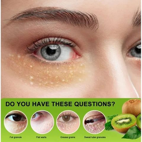 Mụn Thịt Quanh Mắt - Kem Mắt Vitamin E Nguyên Chất Giảm Thâm, Xóa Nhăn, Căng Bóng