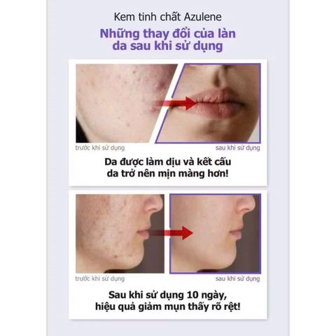 (CHÍNH HÃNG) Kem Dưỡng Da DLK Azulene Ampoule Cream Hỗ Trợ Phục Hồi Và Làm Dịu Da Nhạy Cảm - 50g