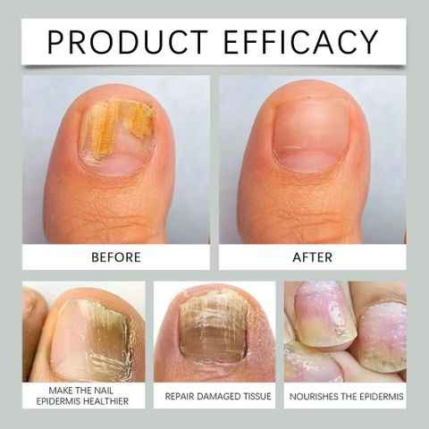 Serum Tẩy Nấm Móng Tay Chân Thảo Mộc Giúp Loại Bỏ Nấm, Kháng Khuẩn, Phục Hồi Móng Cứng Chắc Khỏe Tràm Trà & Gừng 7 DAYS