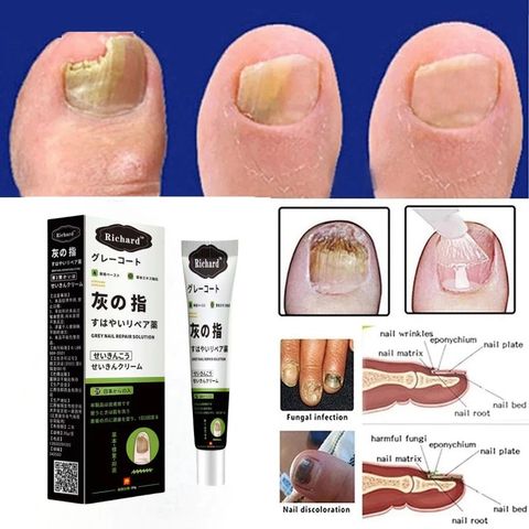 Kem bôi nấm móng tay Nhật Bản 20G