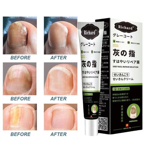 Kem bôi nấm móng tay Nhật Bản 20G