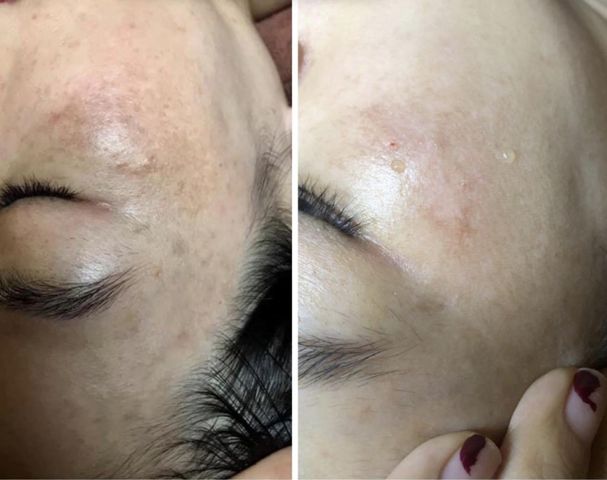 INNOAESTHETICS LIGHTENING A CREAM sản phẩm peel da mụn ẩn, Giải pháp hoàn hảo cho làn da mịn màng và đều màu