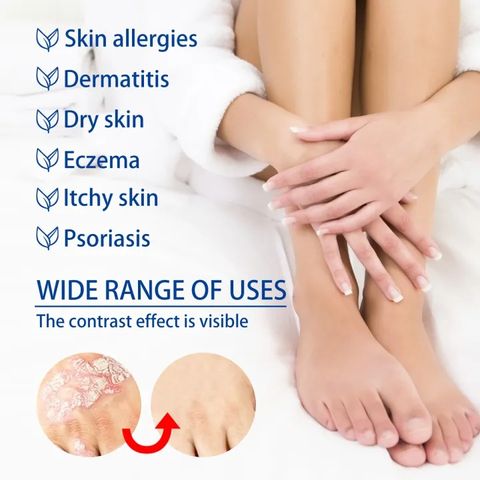 Kem bôi vẩy nến, viêm da kháng khuẩn đánhh bayy nấm da, chống ngứa viêm da, viêm da cơ địa, á sừng, vảy nến