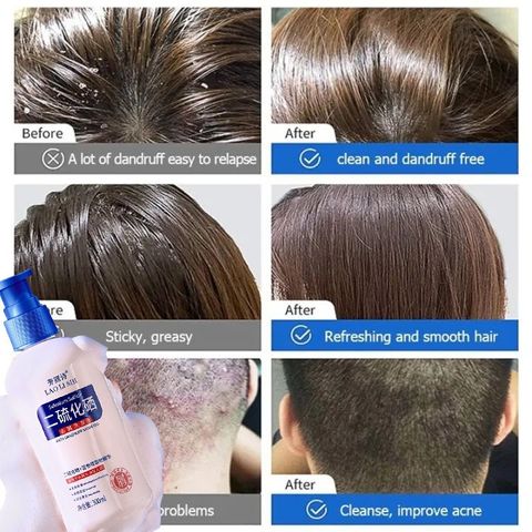 Dầu gội sạch gàu Dầu Gội gội loại bỏ mạt dầu gội giảm ngứa 300ml Làm sạch sâu da đầu, loại bỏ ve, loại