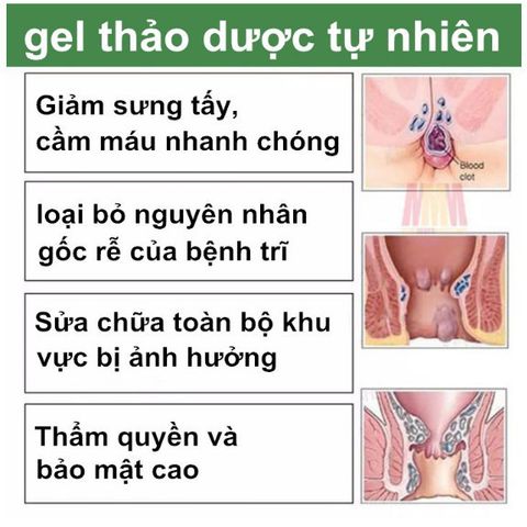 Nhật Bản Kem thảo dược bôi trĩ co búi trĩ giảm đau do trĩ