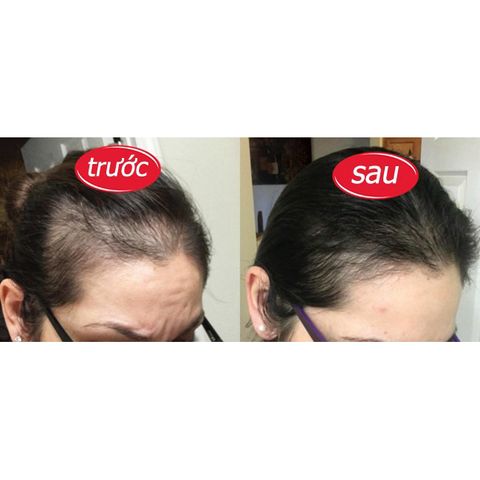 Viên uống hỗ trợ làm đen và dày tóc Kẽm Biotin (Hộp 30viên)