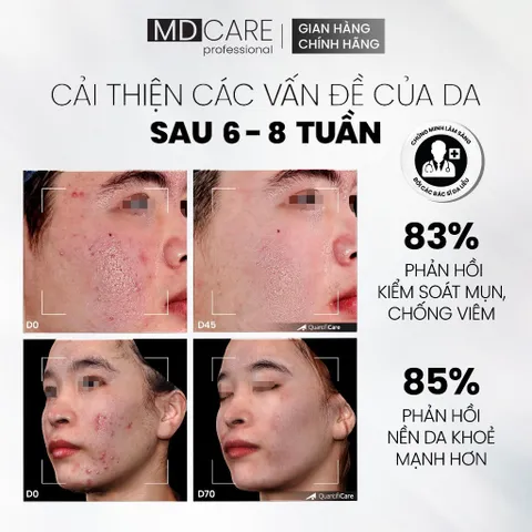 [CHÍNH HÃNG] Tẩy Tế Bào Chết MD CARE AntiAc Exfo 30ml