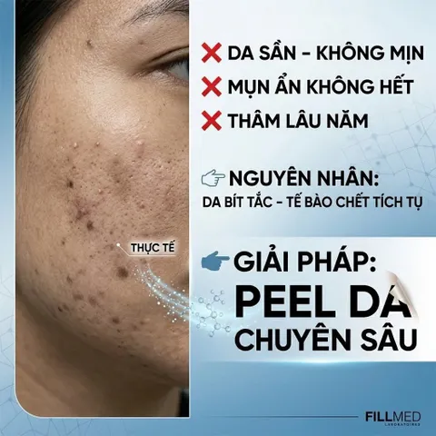 Mặt Nạ Tẩy Da Chết Fillmed Skin Perfusion Glyco Peel 500ml - Làm Sáng, Mịn Da, Cấp Ẩm Chuyên Nghiệp Từ Pháp