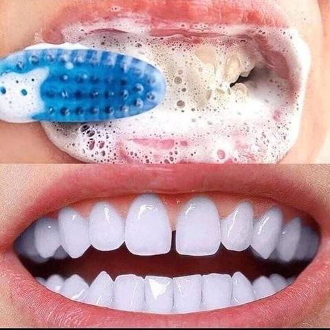 Kem Đánh Răng Median Dental IQ 93% (Màu Ngẫu Nhiên)
