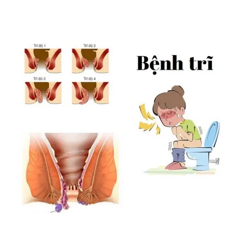 Viên uống QUEE TREE (Kingphar)hỗ trợ giảm đau,chảy máu do trĩ ,táo bón(Hộp 40vien)