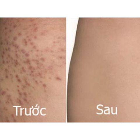 Xịt mụn body và gel tắm ngừa mụn Freeskin hỗ trợ viêm nang lông body