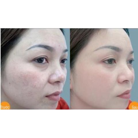 Viên uống Red vitamin E_Dầu thông đỏ giúp dưỡng ẩm da và giảm sạm da do lão hoá(Chai 30 viên)