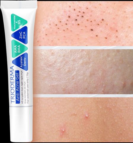 Gel chấm mụn Trioderma  Anti Acne Gel hỗ trợ giảm mụn, mờ thâm dạng tuýp 15g