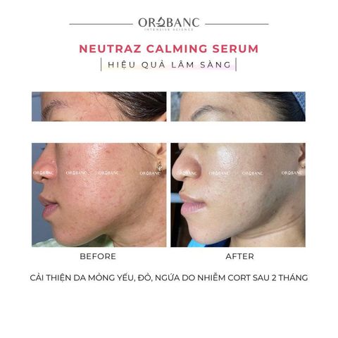 Tinh chất làm dịu, giảm đỏ | NEUTRAZ CALMING SERUM Orobanc