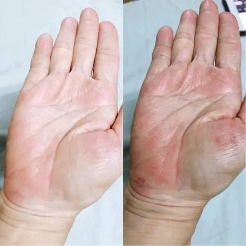 Kem Bôi Clinoderm 15g Thái Lan Ngăn Ngừa Nấm Móng Tay Chân Vảy Nến