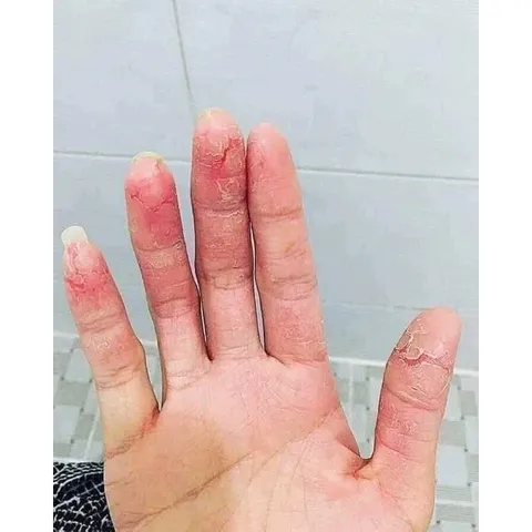 Kem Bôi Clinoderm 15g Thái Lan Ngăn Ngừa Nấm Móng Tay Chân Vảy Nến