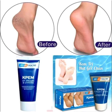 Kem Kpem Giảm Và Phục Hồi Nứt Nẻ Gót Chân Kpem 50ml xuất xứ Nga