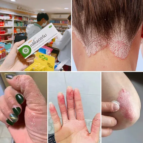 Kem Bôi Clinoderm 15g Thái Lan Ngăn Ngừa Nấm Móng Tay Chân Vảy Nến