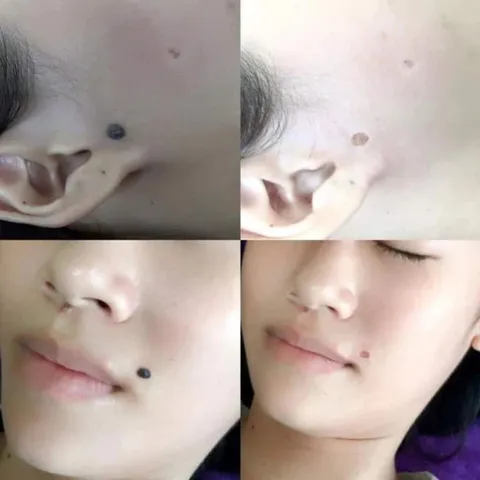 Gel tẩy nốt ruồi mụn cóc mụn thịt  tàn nhang, sẹo lồi Dvelinil - Hàng Nga Chính Hãng