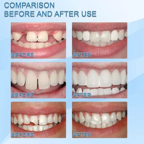 Keo dán răng Nhựa Nha Khoa Tạm Thời Bộ Dụng Cụ Sửa Chữa Răng Và Khoảng Cách Răng Giả Tiện Dụng