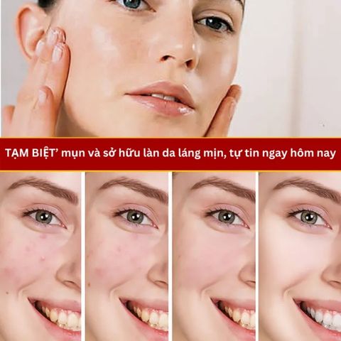 Kem Giảm Mụn Cấp Tốc Loại Bỏ Mụn và Vết Thâm Hoàn ToànThu Nhỏ Lỗ Chân Lông CYSTIC Acne Giúp DaLáng Mịn Khít Lỗ Chân Lông
