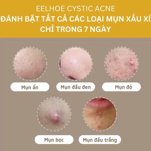 Kem Giảm Mụn Cấp Tốc Loại Bỏ Mụn và Vết Thâm Hoàn ToànThu Nhỏ Lỗ Chân Lông CYSTIC Acne Giúp DaLáng Mịn Khít Lỗ Chân Lông