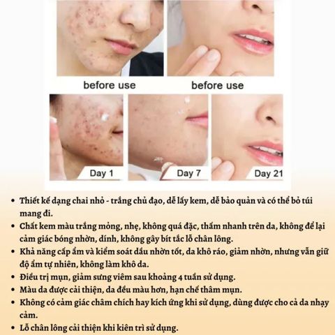Kem Giảm Mụn Cấp Tốc Loại Bỏ Mụn và Vết Thâm Hoàn ToànThu Nhỏ Lỗ Chân Lông CYSTIC Acne Giúp DaLáng Mịn Khít Lỗ Chân Lông
