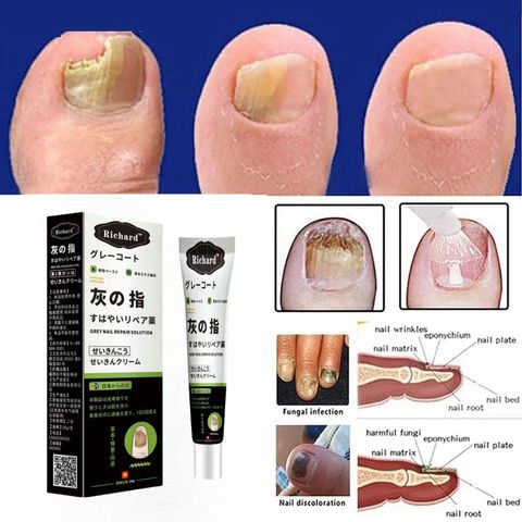 Kem bôi nấm móng tay Chân Hết Sạch Nấm, Bọng Móng, Dưỡng Cứng Móng Nhật Bản 20G