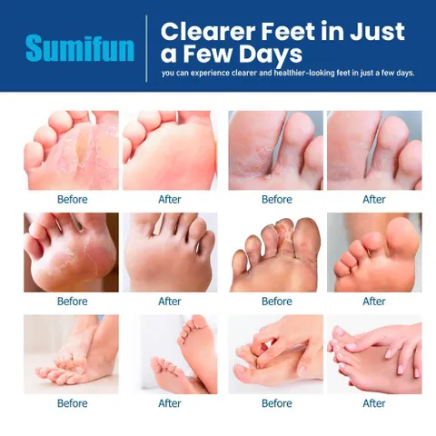 KEM BÔI NẤM ĂN CHÂN BAN ĐÊM–NIGHTTIME ATHLETE’S FOOT CREAM-THẢO MỘC 100%-ÊM-DỊU-NHẸ-RẺ[CHE TÊN KHI GIAO]