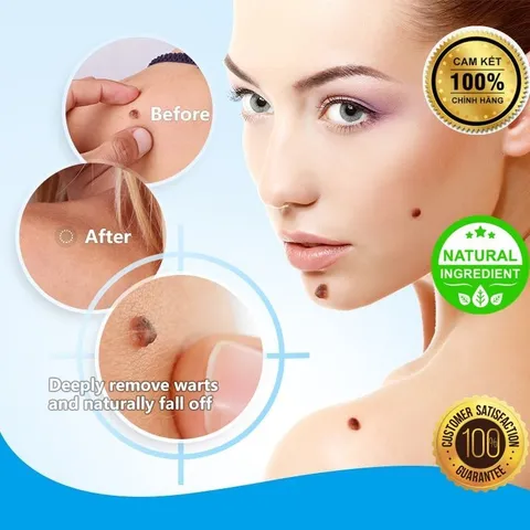Kem Xóa Nốt Ruồi, Tàn Nhang, Mụn Thịt, Mụn Cóc, thành phần thảo dược thiên nhiên, giá rẻ và an toàn