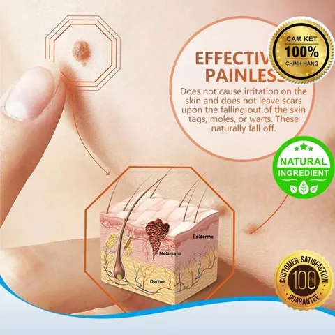 Kem Xóa Nốt Ruồi, Tàn Nhang, Mụn Thịt, Mụn Cóc, thành phần thảo dược thiên nhiên, giá rẻ và an toàn