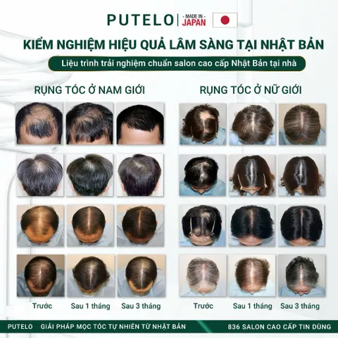 Tinh chất dưỡng da đầu, hỗ trợ mọc tóc, giảm rụng và phục hồi - Putelo AR Essence Uprise 140ml - Chính hãng Nhật Bản