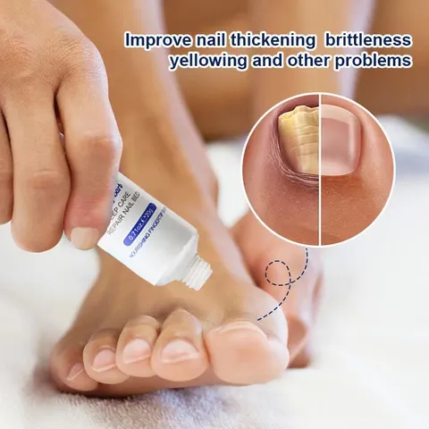 Kem loại bỏ nấm móng Tinh chất phục hồi móng 20g Kem phục hồi móng Móng kháng khuẩn chân loại nấm móng gãy móng chốn