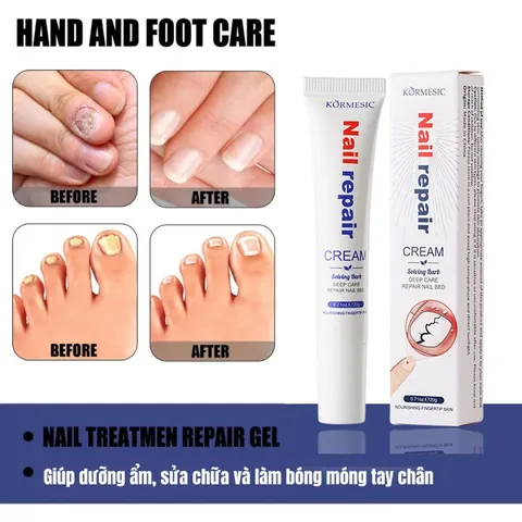 Kem loại bỏ nấm móng Tinh chất phục hồi móng 20g Kem phục hồi móng Móng kháng khuẩn chân loại nấm móng gãy móng chốn